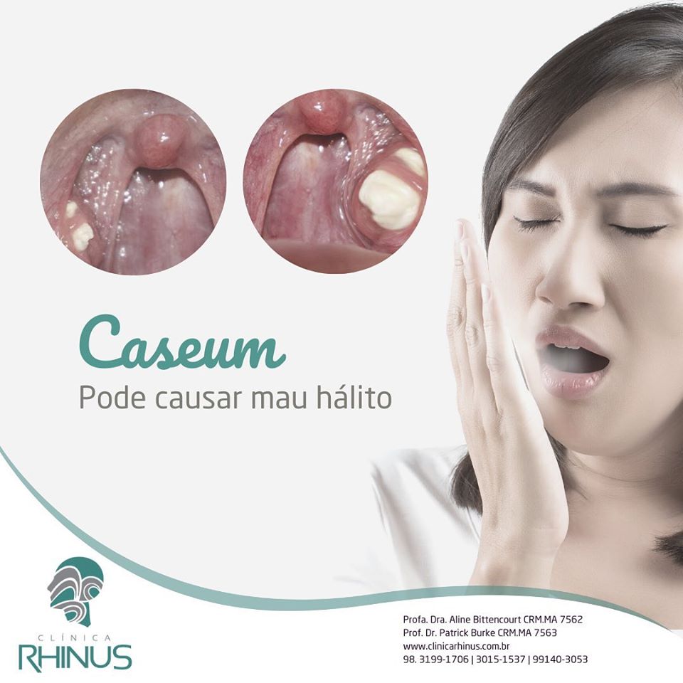 Caseum: bolinha branca na garganta. Causas, prevenção e como